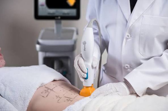 thermage abs Thermage FLX Myths vs. Facts: Why It’s Still One of Our Top Anti-Aging Treatments